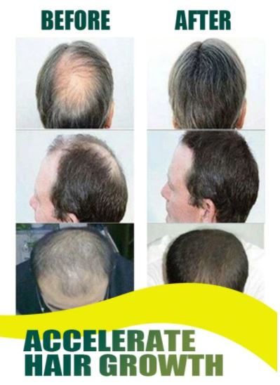 Hair Regrowth Ginger Spray™️ (1 + 1 GRATIS)