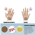 Compressie Handschoen | Pijnvrije handen en vingers